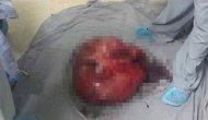 Hamile sanılan kadının karnından çıkan şoke etti