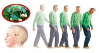 Sinsi İlerleyen Hastalık Parkinson